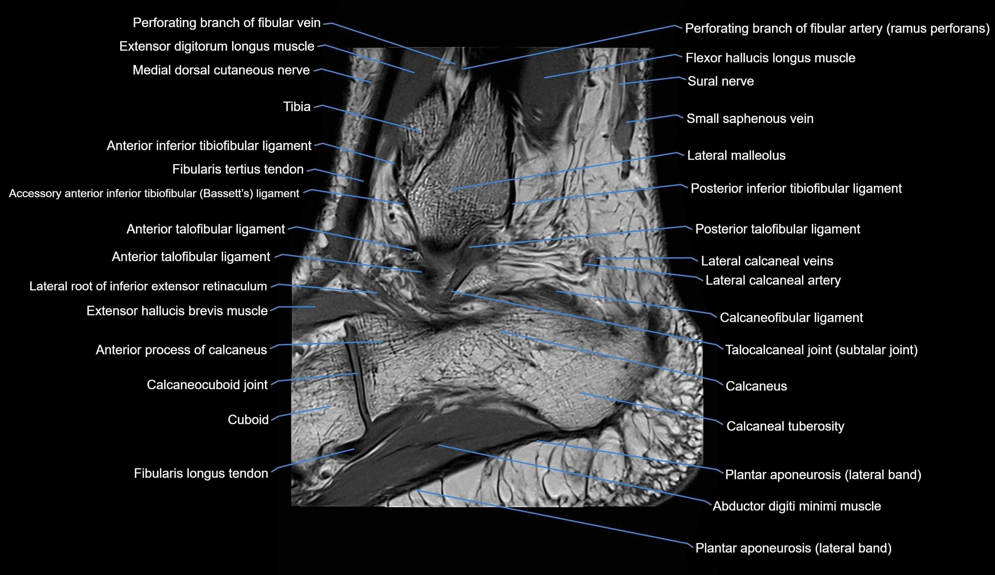 MRI Ankle sagittal cross sectional anatomy 3T  radiology  image-img-00001-00027.webp